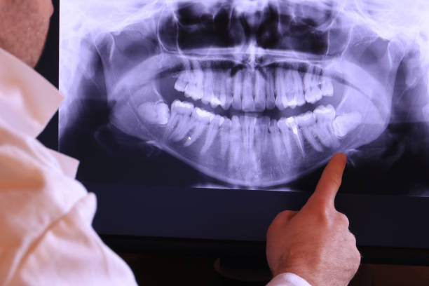Best Knocked-Out Tooth (Avulsed Tooth) Treatment in Wlow Springs, IL